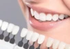 Our Services Veneer Gigi
